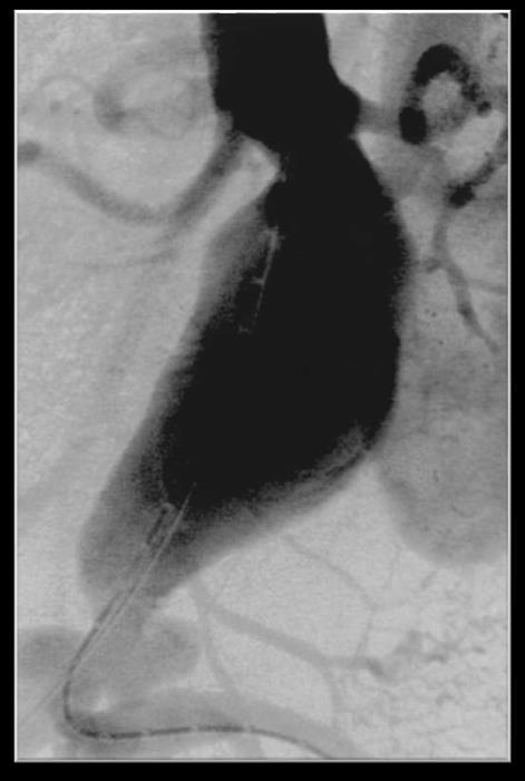 endovascular aortic aneurysm repair Chaikof EL et