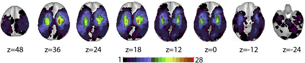 Figure 5. Topography of Stroke Lesion overlay map in atlas space. Color scale: number of subjects with lesions at each voxel. but also right posterior parietal and underlying white matter damage.