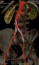 Introduction Chronic lower extremity arterial insufficiency may exist in 2% of patients undergoing TKA Acute peripheral arterial occlusion after TKA has been