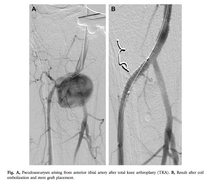 Vessel injury during TKA Indirect vessel injury is the most common mechanism for vascular injury during TKA: - mechanical stretching - compression - thermal injury from cement Direct vessel injury is