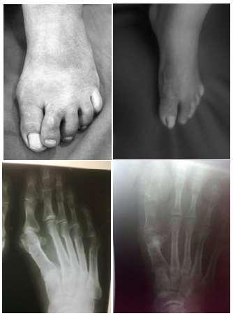 tissue procedures like McBride s procedure to arthodesis of 1 st metatarsophalyngeal joint. 5 Hawkins and associates first described an osteotomy of distal metatarsal to correct hallux vulgus in 1945.