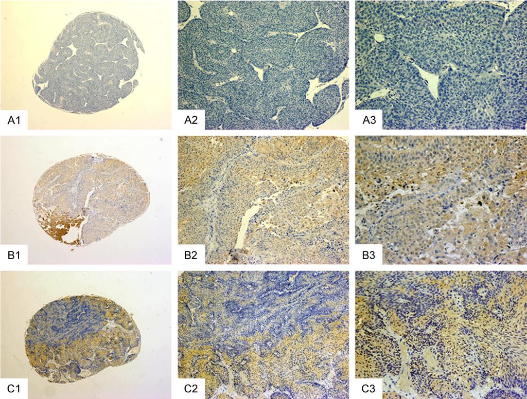 Figure 1. Immunohistochemical staining for FAK in normal and cancerous bladder tissue. A1-A3: Immunostaining of FAK in normal bladder tissue.