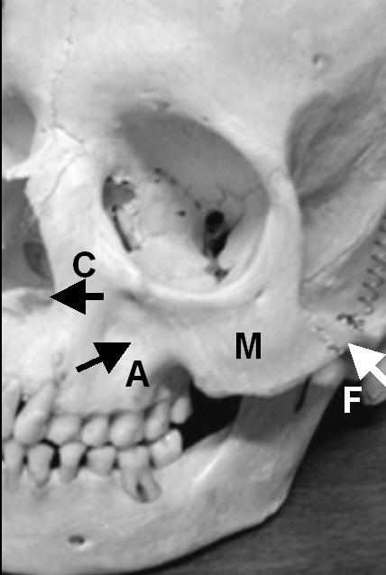 Plates, (M) Zygoma, (N) Hamulus, (R) Torus Palatinus, (S) Intermaxillary Suture seen either superimposed on, between, or above the apices of the teeth.