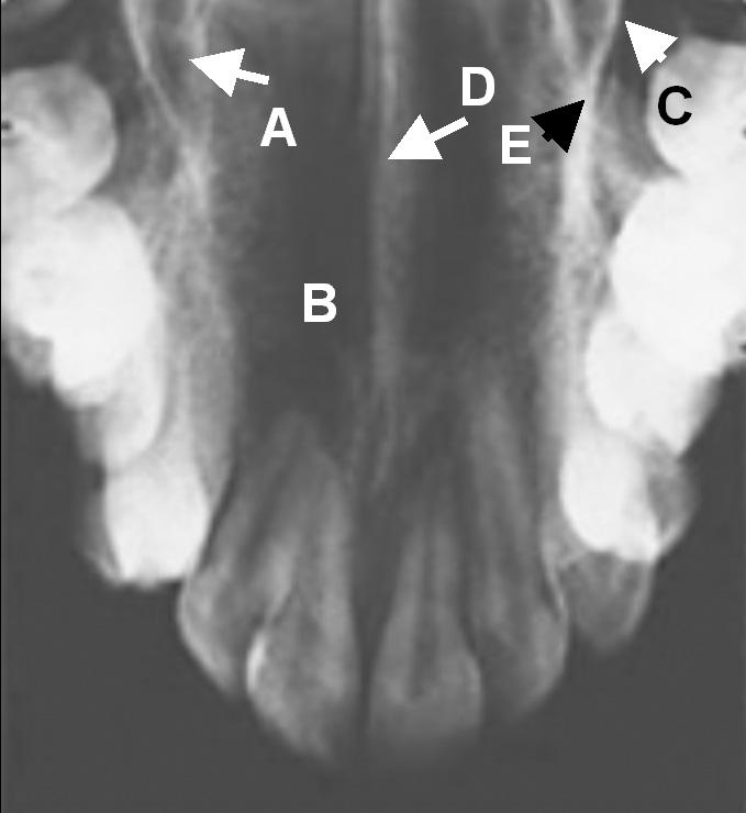 (B) Nasal fossa, (C) Lateral wall of nasal fossa, (D) Intermaxillary suture, (E) Inverted Y. 5) Cephalometric radiographs (Fig.