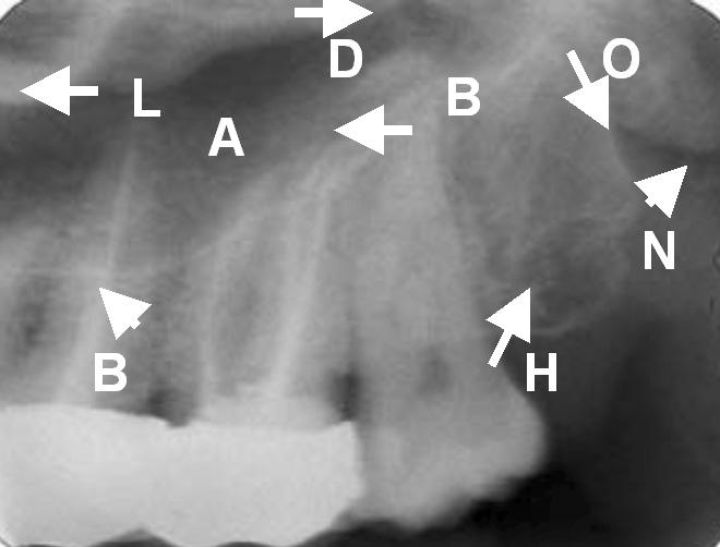 9, 10, 11, 12, 13, 14: Maxillary Molar Area: (A) Maxillary Sinus, (B) Floor of
