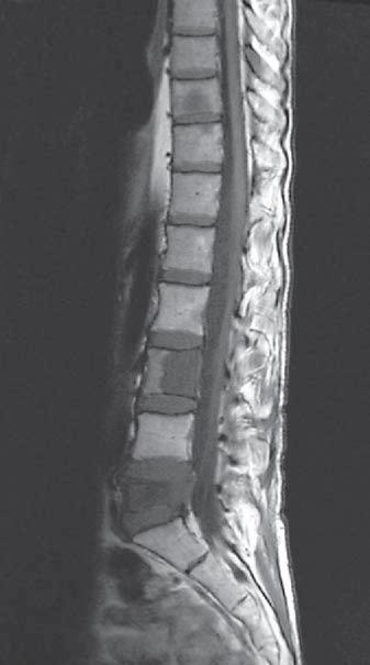 Fig. 9. Sagittal T 1 -weighted MR image of the spine showing hypointense midgut carcinoid bone metastases most evident in the vertebral bodies of thoracic vertebra 10 and lumbar vertebrae 3 a nd 5.