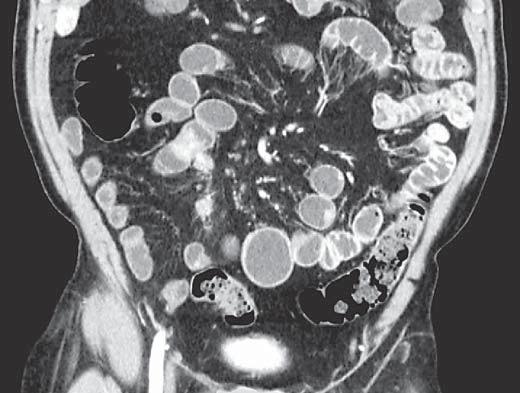 Fig. 2. CT enteroclysis of a contrast-enhancing carcinoid tumor in a small bowel loop (thick arrow). Adjacent to the tumor there are two small contrast-enhancing mesenteric metastases (thin arrows).