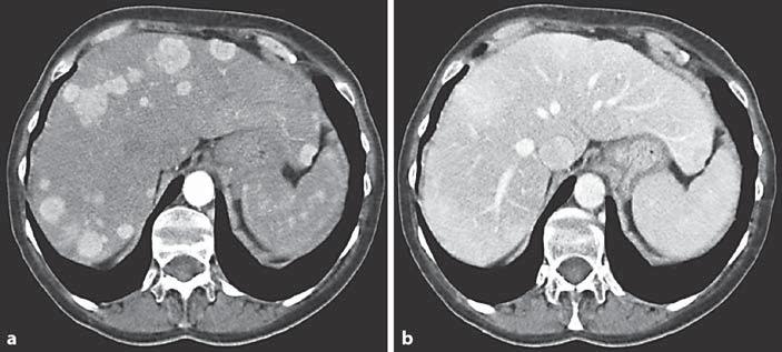 Fig. 3. a Transaxial CT image during i.v. contrast enhancement in the portal-venous inflow phase of several well-vascularised midgut carcinoid liver metastases.