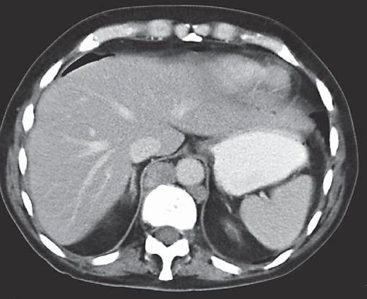 Fig. 5. Transaxial CT image during i.v. contrast enhancement in the venous phase of two metastases in the right thorax in front of and behind the inferior vena cava, respectively (arrows).