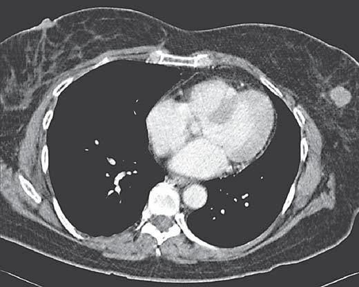 Fig. 6. Transaxial CT image during i.v. contrast enhancement in the venous phase of a metastasis in the left breast from a lung carc i noid. Fig. 7. Transaxial CT image during i.v. contrast enhancement in the venous phase of a patient with midgut carcinoid who has developed peritoneal carcinosis.