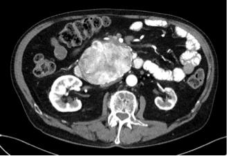 in the uncinate process of the pancreas. Figure 3. Transve
