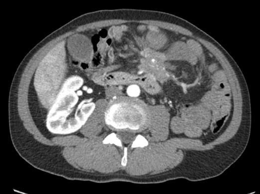 There is tumor encasement of the spleenic and main hepatic artery (arrows). Figure 5. Transve