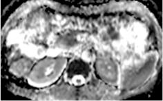 Neuroendocrinology (DOI:10.1159/000471879) 2017 S. Karger AG, Basel 59 Figure 12. Poorly differentiated pancreatic NET in the head. A. Transverse T2-weighted MRI showing the pnet slightly hyperintense (arrow).