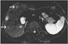Transverse T1-weighted gadolinium contrast-enhanced MRI in the arterial (A)