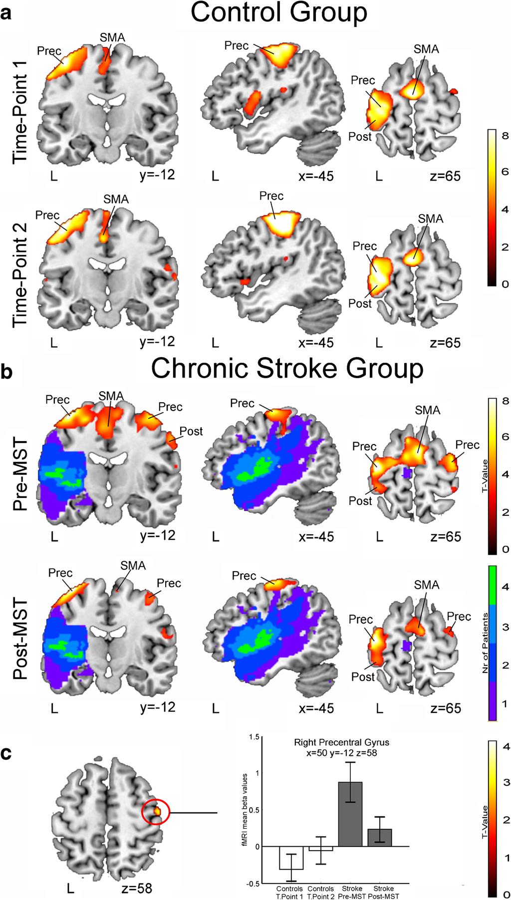 Brain Imaging and Behavior Fig. 2 Enhanced group-level fmri-signals for the motor Sequence versus Rest contrast of the affected hand. Neurological convention is used.