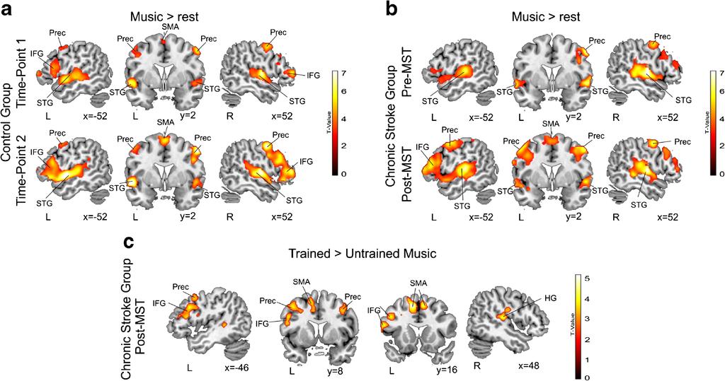Brain Imaging and Behavior Fig. 3 Enhanced group-level fmri-signals for the music task. Neurological convention is used.