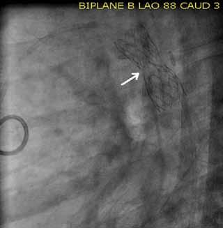 balloon catheter is inflated, completely deploying the stent across the coarctation segment.