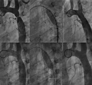 A B C A B C D E D E F F Figure 4. Aortic dissection after stent placement in a 42-yearold woman with native CoA. Angiography (A-C), computed tomography of the chest with contrast (D-G).
