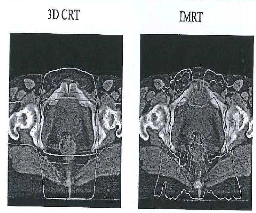 2.2 Radiotherapy 2 BACKGROUND Figure 5: Difference in dose shaping between CRT and IMRT. Image from IAEA.org Figure 6: Illustration of MLC:s in operation.