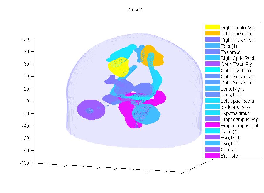 4.2 Case 2: Two tumours 4 RESULTS AND DISCUSSION Figure 55: Mesh of the head, where tumour and organs at risk are outlined and the DVH from the resulting Gamma Knife dose distribution.