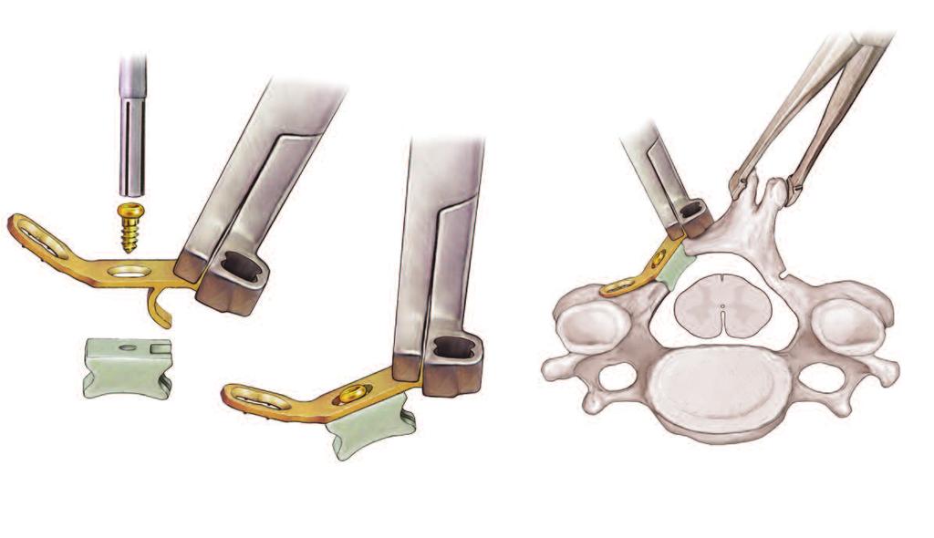 OPERATIVE TECHNIQUE 5 Fig. 6 Fig. 7 6. PLATE GRAFT ASSEMBLY Attach the lamina screwdriver to the modular handle. Secure the allograft strut to the plate at the center screw position.