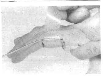 (Note: The PIP joint axis is located where the PIP flexion crease intersects the midlateralline of the finger.