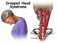 Most of the time, Dropped Head Syndrome is caused by a specific generalized neuromuscular diagnosis. When the cause is not known, it is called isolated neck extensor myopathy, or INEM.