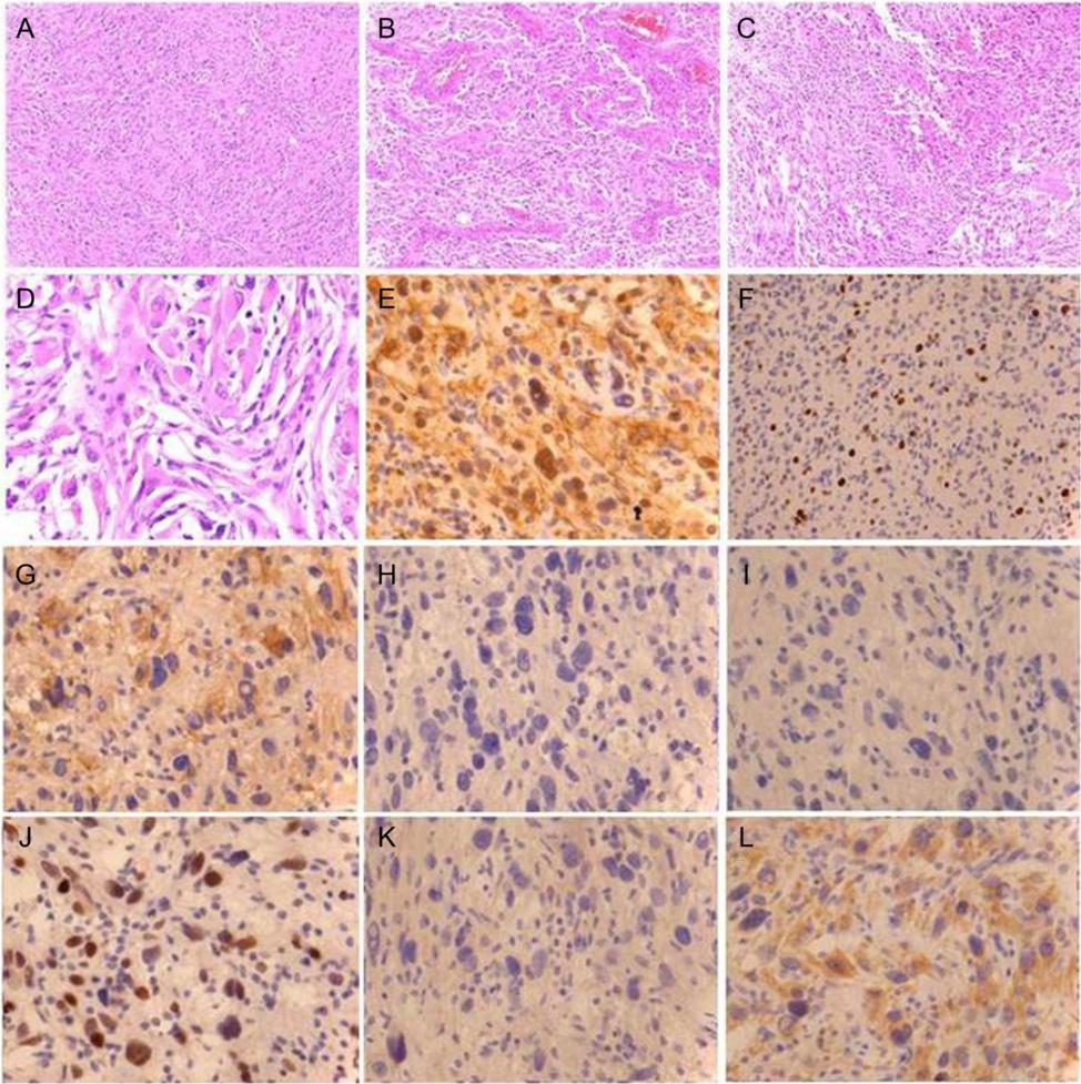 Takahashi et al. World Journal of Surgical Oncology (2015) 13:100 Page 3 of 5 Figure 2 Histopathological features of the BRAF V600E-positive glioblastoma. (A-D) Hematoxylin and eosin (H & E) staining.