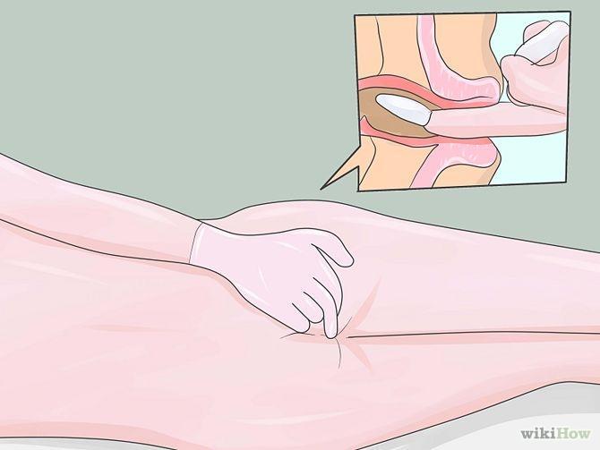 4. Lubricate the area around the anus with water soluble lubricant Lubricate the: surrounding skin to ease the application the suppository if not already lubricated the gloved finger that will be