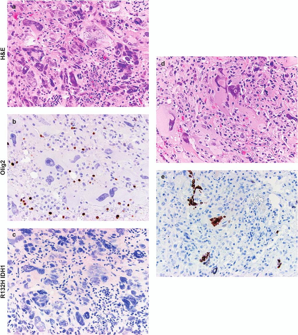 IDH1 and OLIG2 expression in glioblastoma variants 9 NM Joseph et al Figure 6 Giant cell glioblastomas. H&E, OLIG2, and IDH1 stained sections from examples of giant cell glioblastomas.