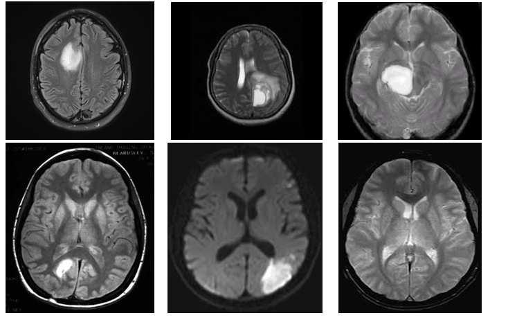 4. RESULTS Some of the brain MR images containing tumor taken for testing our proposed algorithm are shown in Fig 3.
