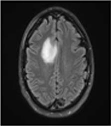 Shows the final clustering of brain MR image after being processed by our algorithm. Fig 5. Shows the final tumor detected portion from the brain MR image. Fig 4. Clustering of brain MR image Fig 5.