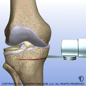 In what is called an opening wedge osteotomy, a cut is made in the shin bone and a bone graft and instrumentation are used to hold the wedge open and realign the knee.