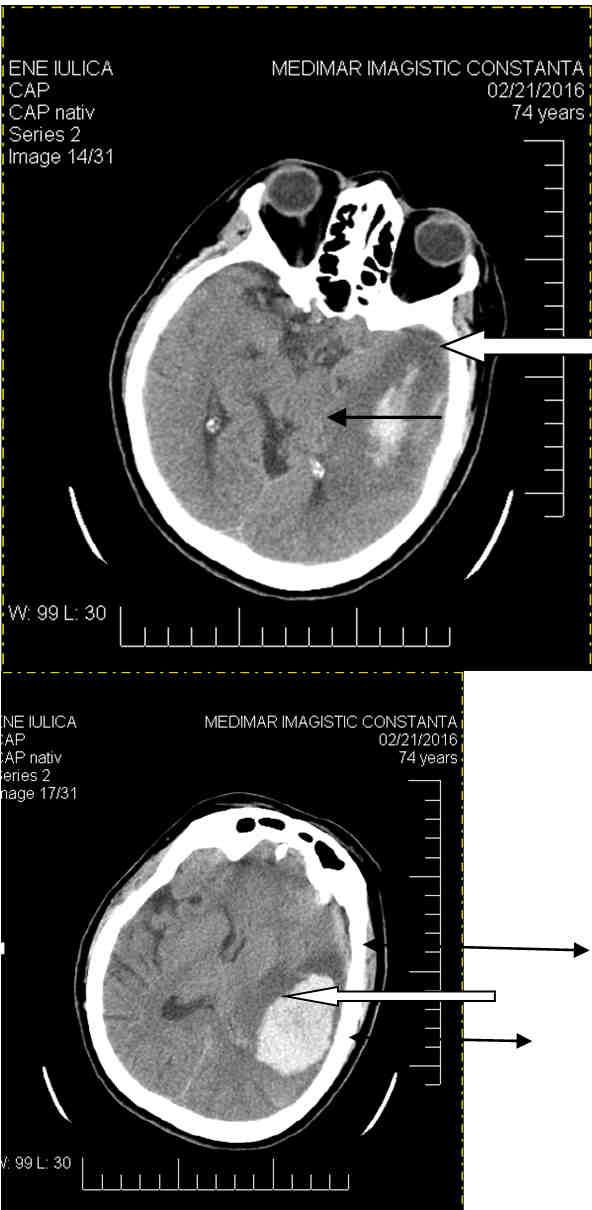 Romanian Neurosurgery (2016) XXX 2: 214-218 215 Introduction Generally, according to the international literature, cerebral ischemia is a secondary posttraumatic lesion produced by direct compression