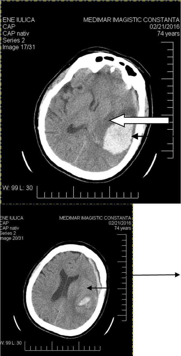216 Balasa et al - Acute cerebral MCA ischemia Figure 5 Figure 6 Postoperative CT Scan: Large hypodense lesion with aspect of stroke in left MCA area (white arrow).