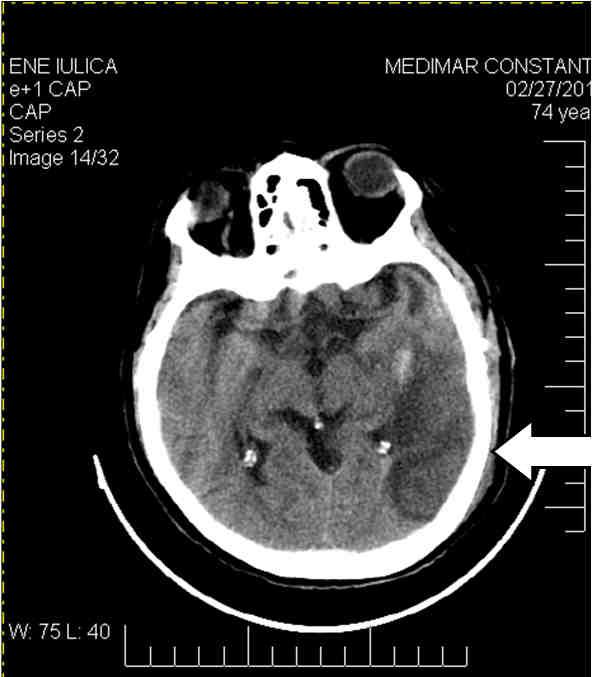 haematomas (black double peak arrows).large hypodense lesion with aspect of a stroke in the left MCA territory (white arrow).