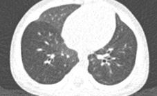 Neuroendocrine cells in bronchioles Needs BOMBESIN stain for diagnosis Symptoms out of proportion to minor biopsy findings Rarely hospitalized, does not respond to steroids Characteristic
