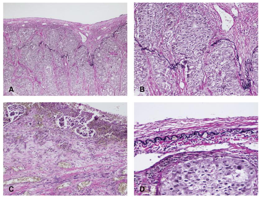Background Documentation Classification of adenocarcinomas by predominant histologic pattern can be useful for assessing pathologic grade.