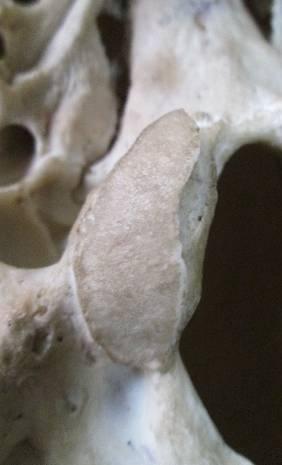 of occipital condyle of male skulls was higher than the female skulls with statistical significant difference (p<0.05).