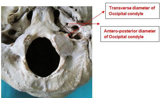 The occipital condyle index (APD/TD) was higher in male skulls with (p<0.05) statistical significant difference.