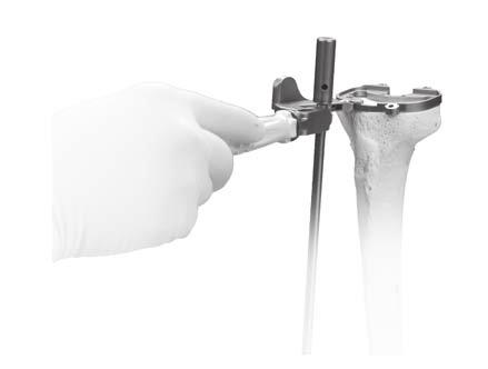 Zimmer NexGen MIS Tibial Component Cemented Surgical Technique 3 Technique Tip - use the alignment rod in the hole or slot in the MIS Sizing Plate Handle to verify proper tibial plate varus/valgus
