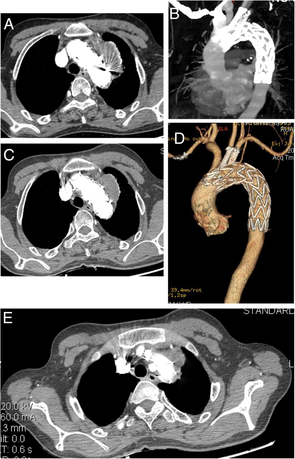 Zhou et al. Journal of Cardiothoracic Surgery 2013, 8:80 Page 3 of 5 enlargement of the pseudoaneurysm. The endoprosthesis intheaorticarchwerepatent,withoutevidenceofproximal endoleak.