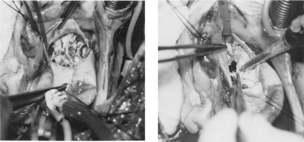 60 SHEPPARD ET AL Ann Thorac Surg 99;5:594 Fig. (This and all subsequent figures are of patient 55.) Heavily calcified bicuspid aortic valve. Fig 3.