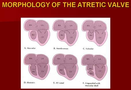 NEONATOLOGY TODAY News and Information for BC/BE Neonatologists and Perinatologists Volume 7 / Issue 5 May 2012 IN THIS ISSUE Tricuspid Atresia in the Neonate by P.