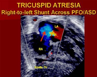 In the most common muscular type, a dense band of echoes is seen at the site where tricuspid valve should be 55,72 and the anterior leaflet of the detectable atrioventricular valve is attached to the