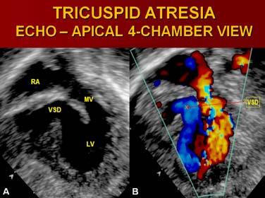Atrial and ventricular septal defects can also be demonstrated by 2D echocardiography.