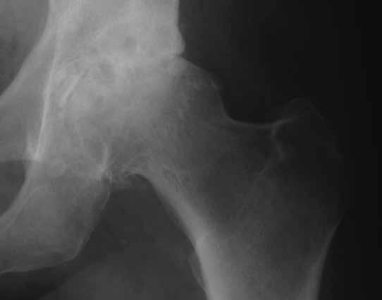 The radiographs should clearly demonstrate the acetabular configuration and the endosteal and periosteal contours of the femoral head, neck and proximal femur
