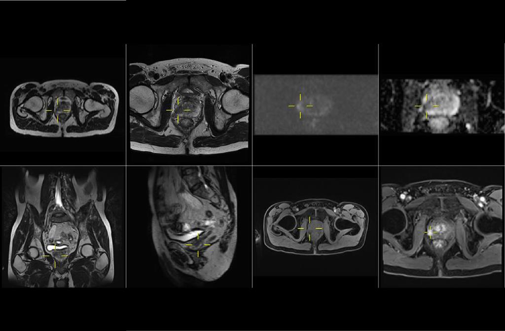 Steiger and Thoeny Cancer Imaging (2016) 16:9 Page 4 of 9 the pelvis with an isotropic voxel of 1 mm to allow reconstruction in the axial and the sagittal plane.