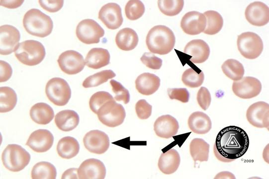 BCP-21 Blood Cell Identification Graded Case History The patient is a 37-year-old female with a history of multiple sickle cell crises. She now presents with avascular necrosis of the left hip.