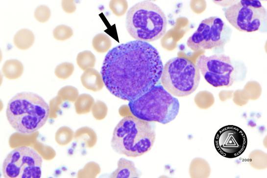 BCP-30 Blood Cell Identification Ungraded Neutrophil, promyelocyte 65 92.9 4548 88.6 Educational Neutrophil promyelocyte, 2 2.9 223 4.4 Educational abnormal with/without Auer rod(s) Blast cell 1 1.
